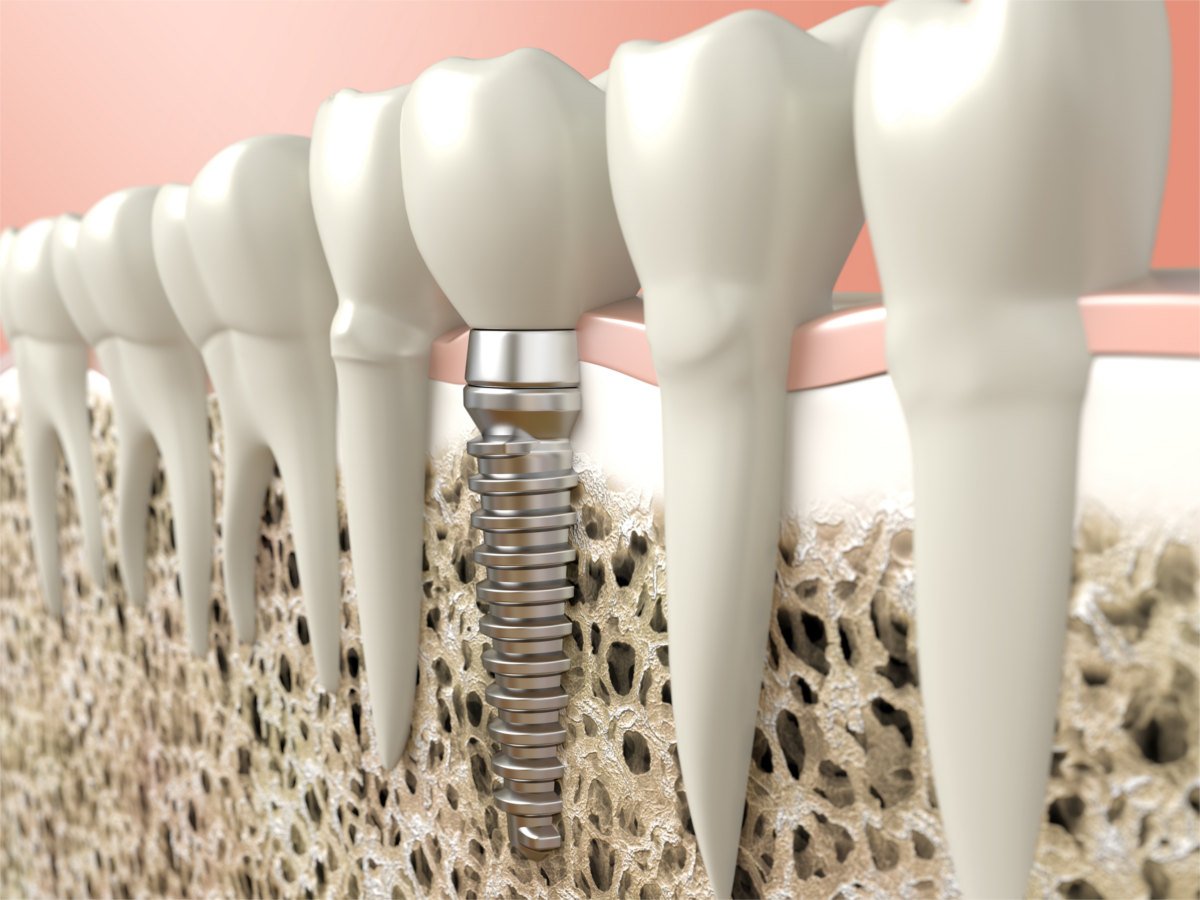 Dental Implants | Kelowna Dentist, Dr. Sandy Crocker