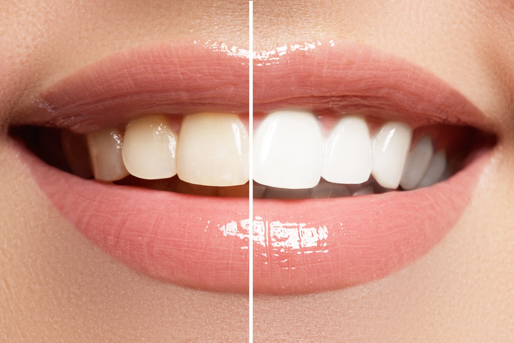 cosmetic dentistry whitening teeth dentist clinic tooth crown veneers kelowna dr sandy dr peter mitchell