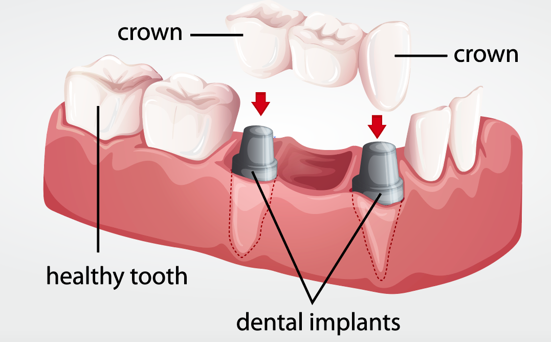 dentistry dental crown implants teeth oral health care dentist dr. sandy dr. mitchell kelowna